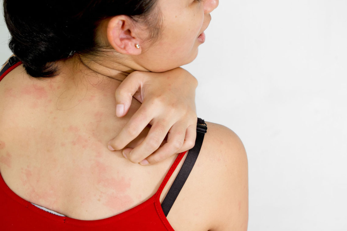 Young woman back with allergy skin problem